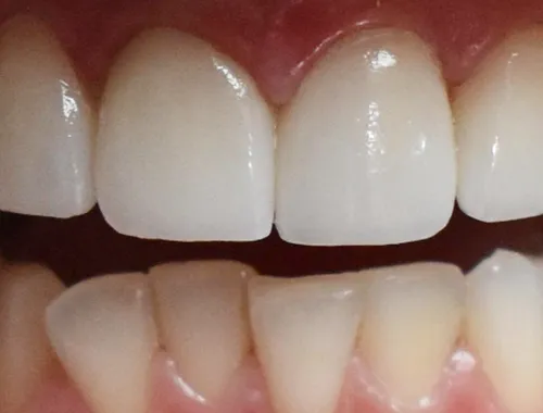 After dental treatment